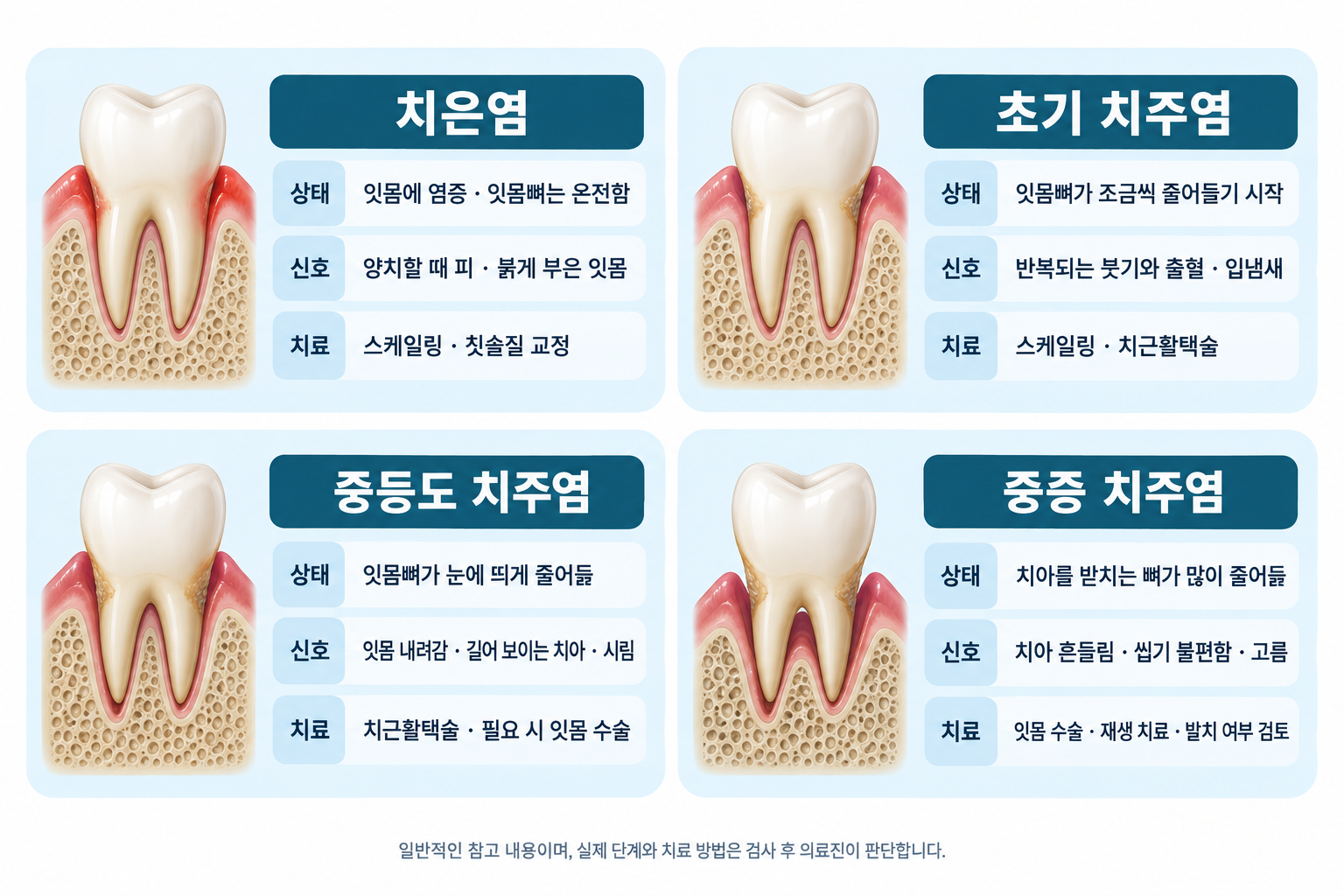 구리 치주염 단계별 잇몸 상태 비교 — 치은염, 초기 치주염, 중등도 치주염, 중증 치주염 설명, 구리 갈매 치과