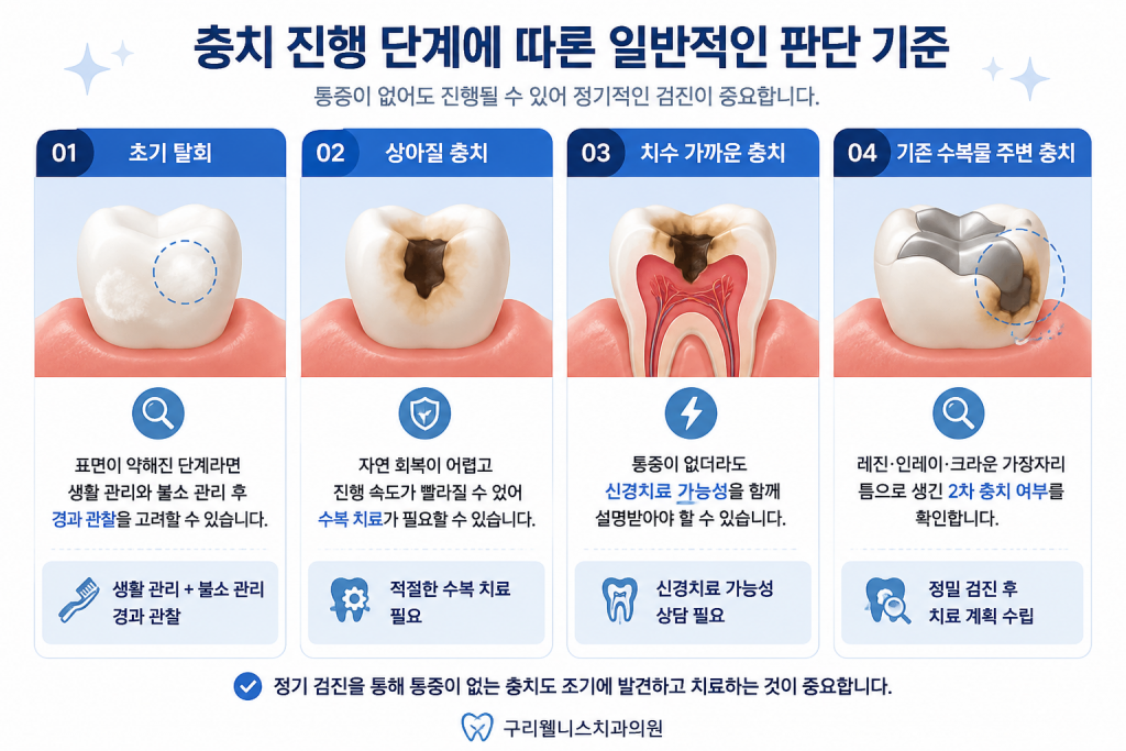 초기 탈회, 상아질 충치, 치수 가까운 충치, 기존 수복물 주변 충치의 일반적인 판단 기준